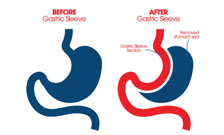 Gastric Sleeve Surgery in St. Louis