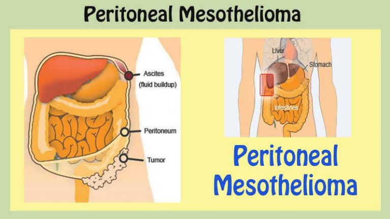Peritoneal Mesothelioma
