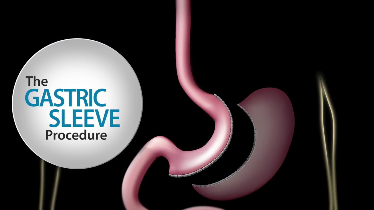 Best Gastric Sleeve Surgery in Roseville
