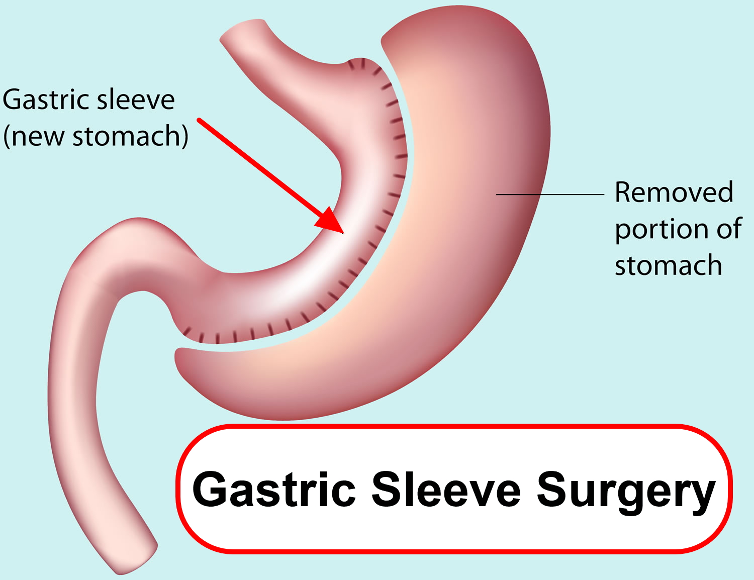 Gastric Sleeve Surgery in Killeen
