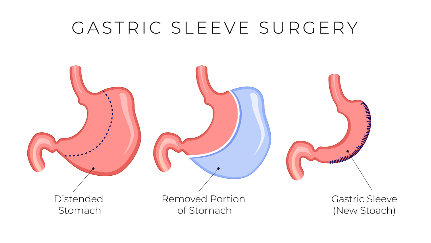 Gastric Sleeve Surgery Salinas
