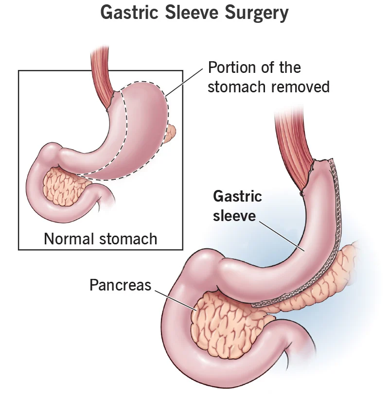 gastric-sleeve-surgery-Springfield