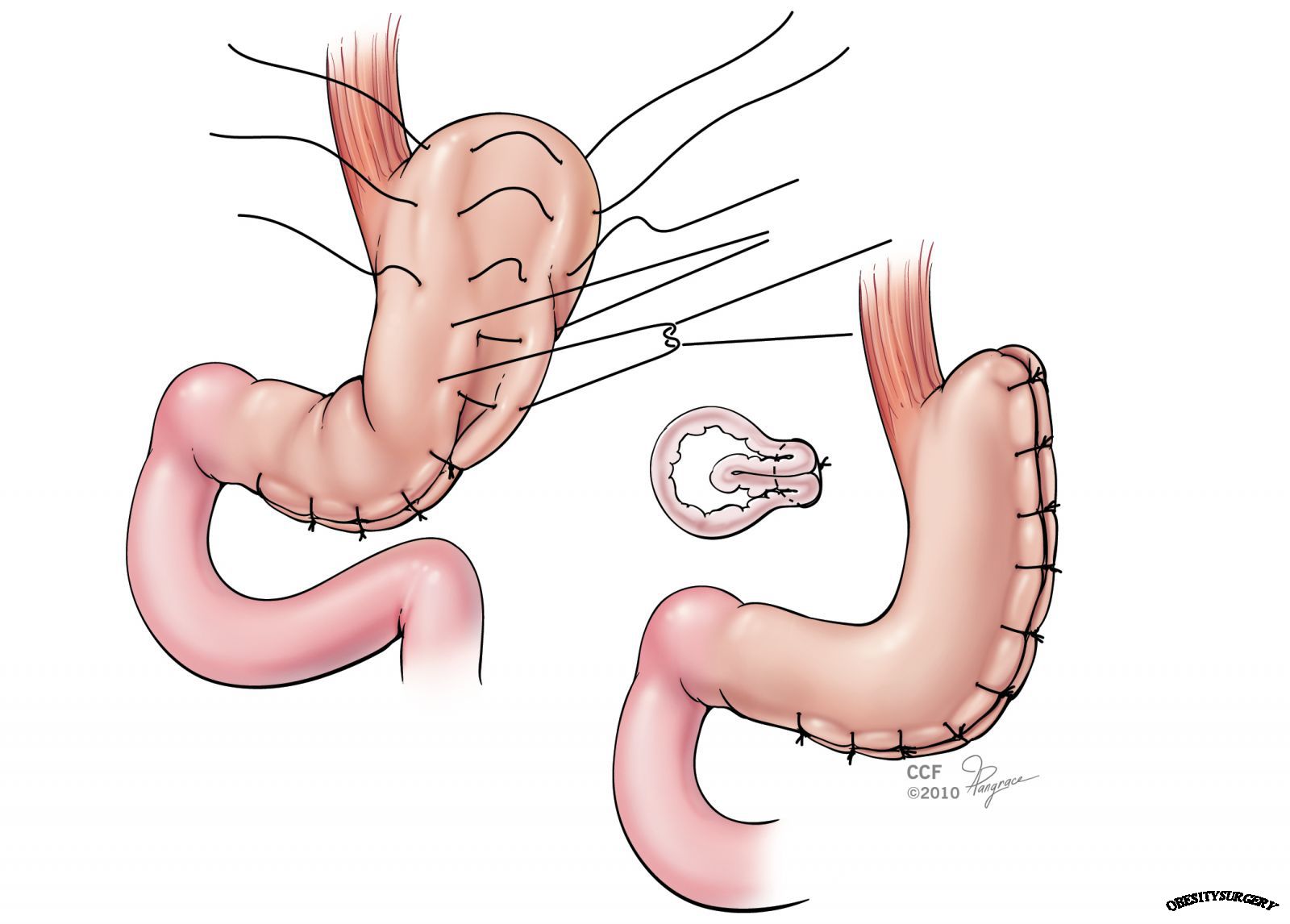 Gastric Sleeve Surgery in Fullerton