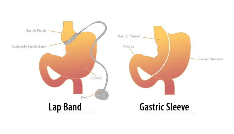 Best Gastric Sleeve Surgery in Arlington
