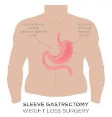 Gastric Sleeve Surgery in Round Rock