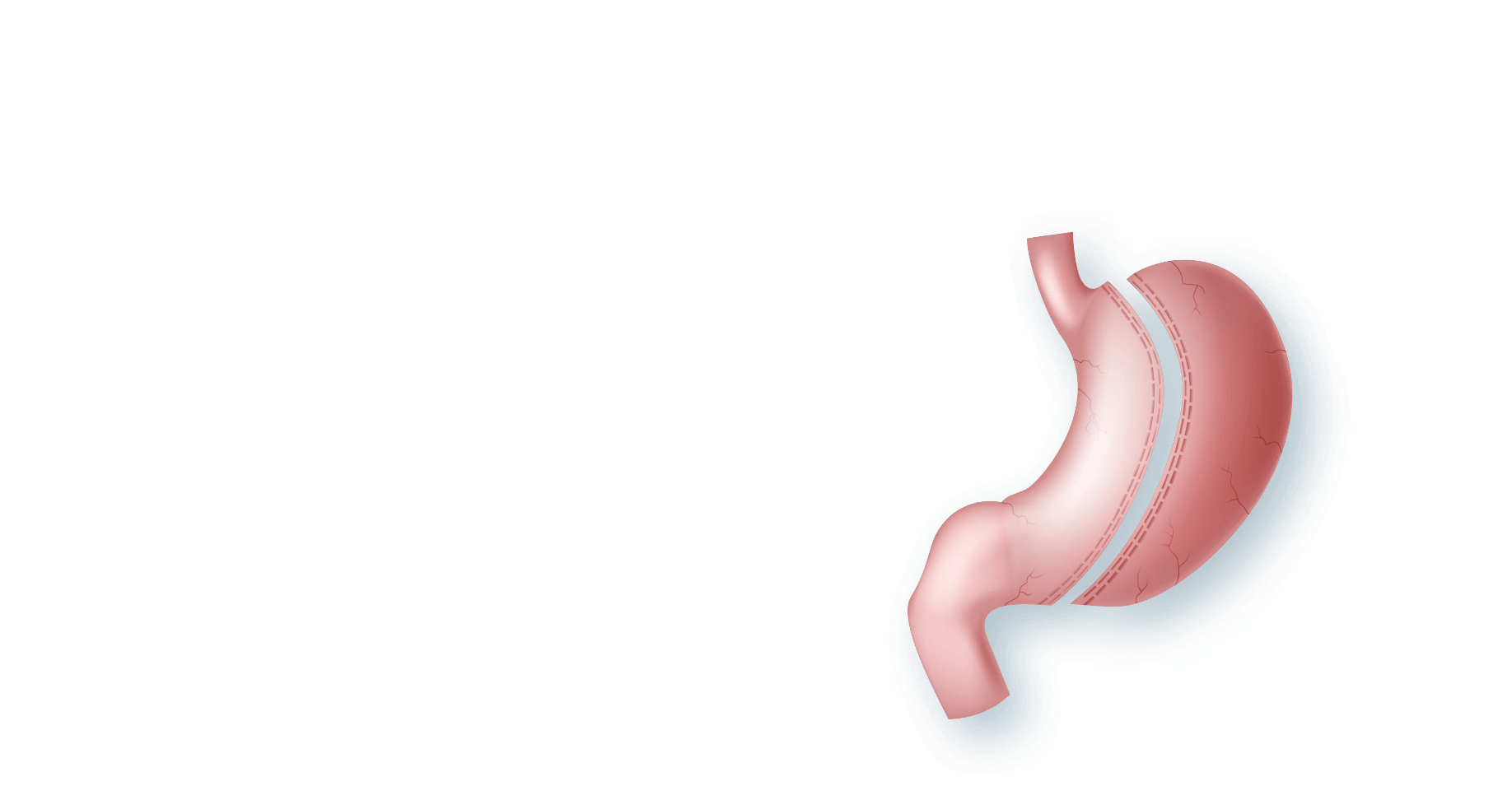 Gastric Sleeve Surgery in Austin