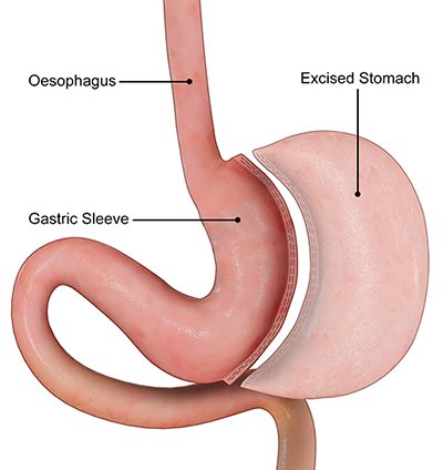 Gastric Sleeve Surgery in Arvada