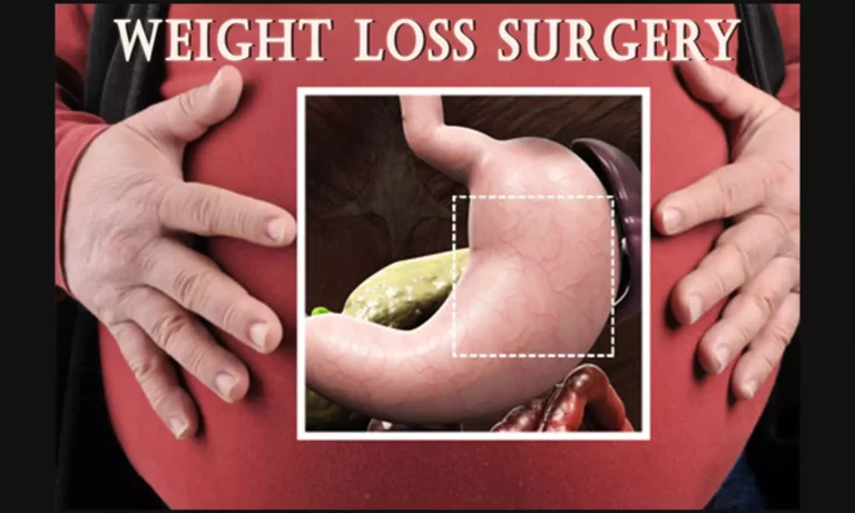 Gastric Sleeve Surgery in Stockton